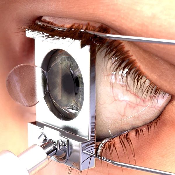 LASIK Animation